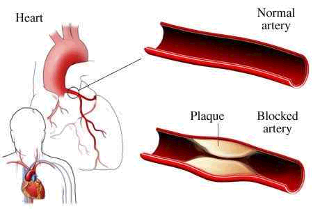 Chelation Therapy