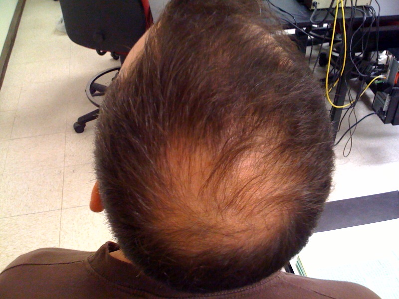 Ozone Therapy for Hair Loss