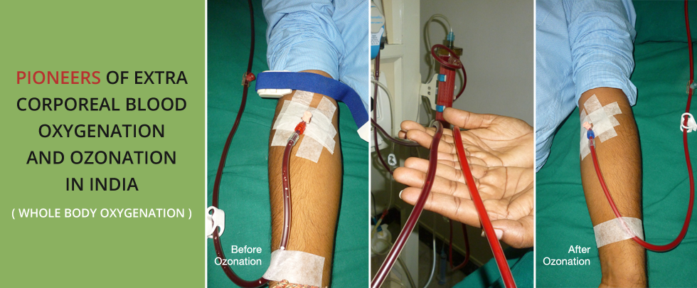 Ozone Therapy in Chennai India